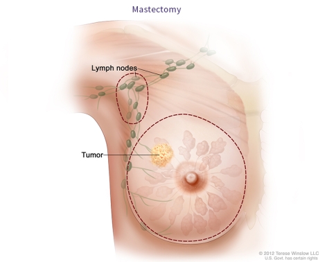 Hormone Therapy for Breast Cancer Fact Sheet - NCI