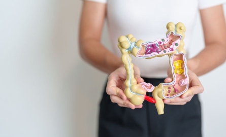Colon Polyps: Are They Cancer?