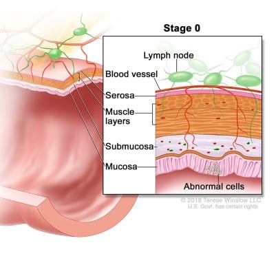 colorectal cancer stage 0 illustration