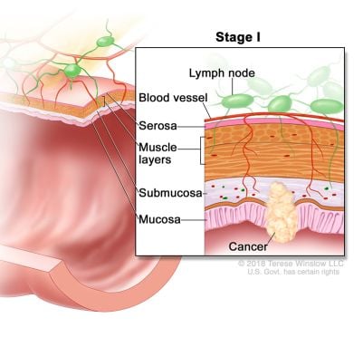 colorectal cancer stage 1 illustration