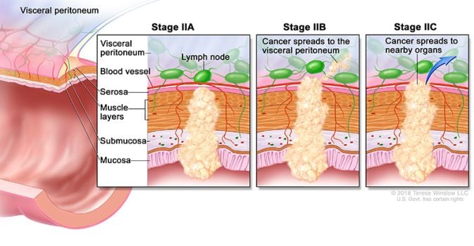 colorectal cancer stage 2 illustration