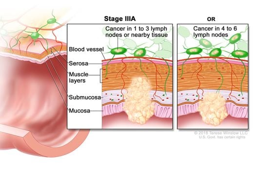 stage 3a colon and rectal cancer