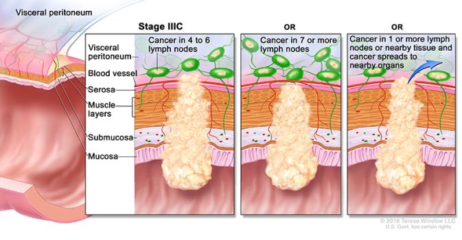 stage 3c colon and rectal cancer