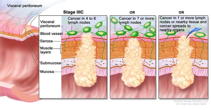 stage 3c colon and rectal cancer