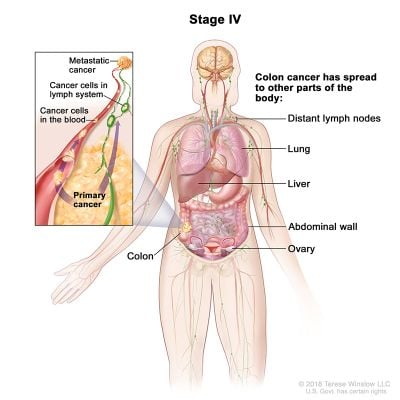 colorectal cancer stage 4 illustration