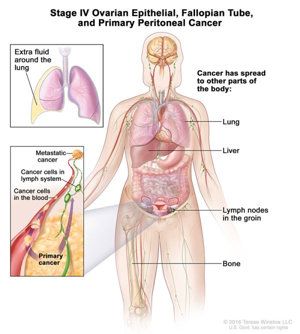 ovarian cancer stage 4