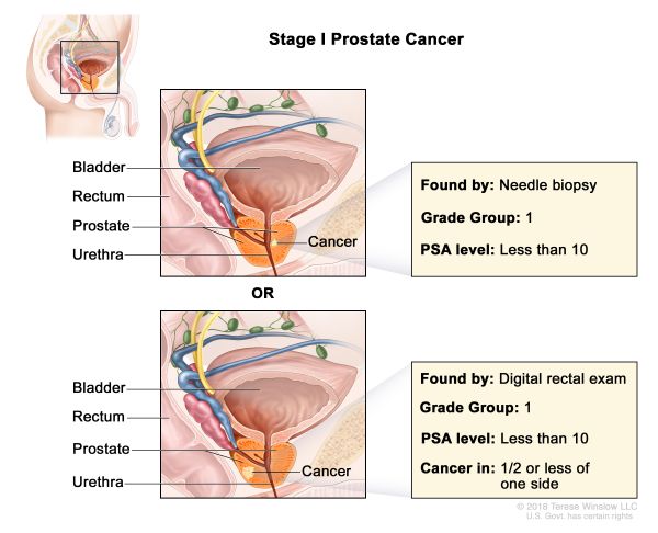 Prostate Cancer Stage 1