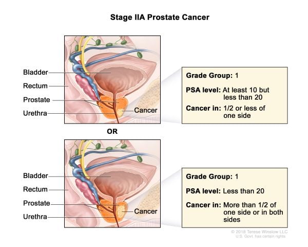 Prostate Cancer Stage 2A