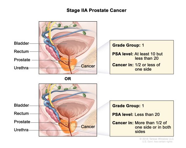 Prostate Cancer Stage 2A