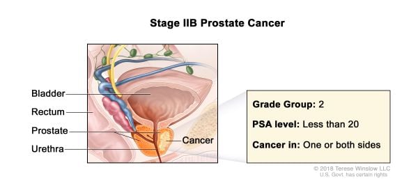 Prostate Cancer Stage 2b