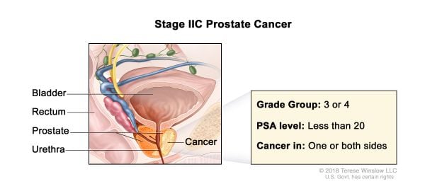 Prostate Cancer Stage 2c