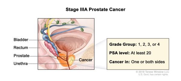 Prostate Cancer Stage 3a