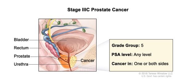 Prostate Cancer Stage 3c