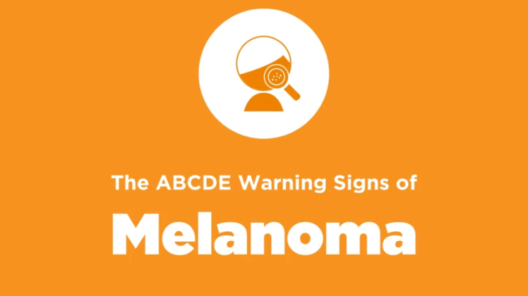 ABCDE Warning Signs of Melanoma