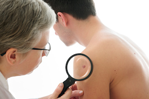 Types of Skin Cancer