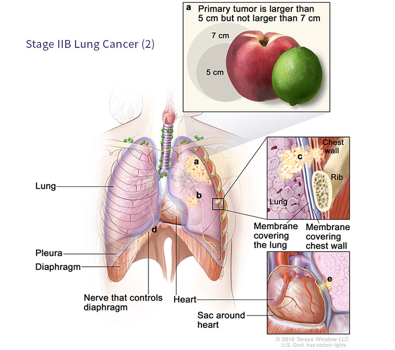 Lung Cancer Staging Virginia Oncology
